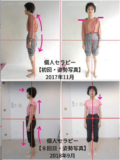 姿勢が大改善し、股関節痛も改善！～念願叶って、再び友人と満開の桜 